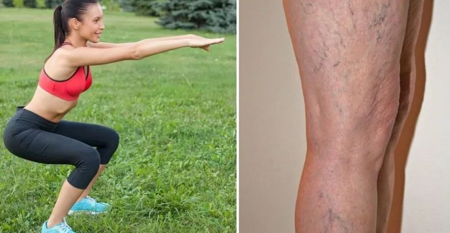 Piernas para venas varicosas