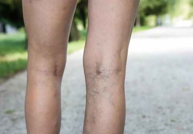 Varices