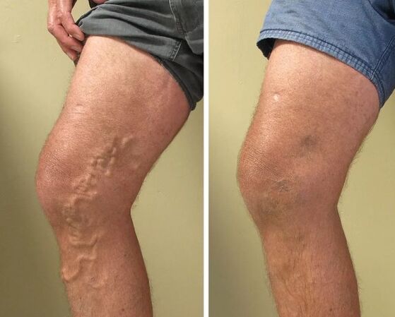 Venas varicosas antes y después del tratamiento