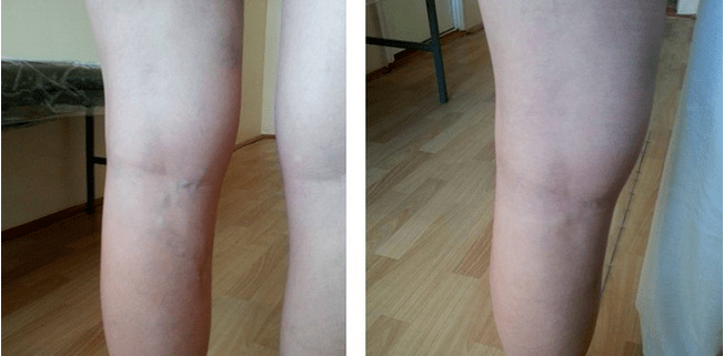 venas varicosas en las piernas